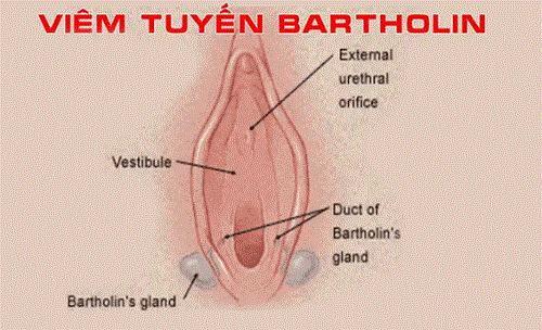 Viêm tuyến bartholin